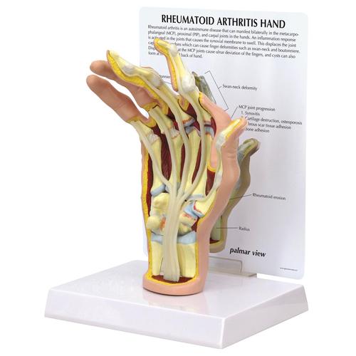 Handmodell mit rheumatoider Arthritis, 1019521, Hand- und Armskelett Modelle