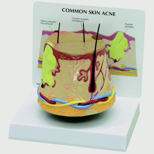Modell einer Hautakne (überdimensioniert), 1019567, Hautmodelle
