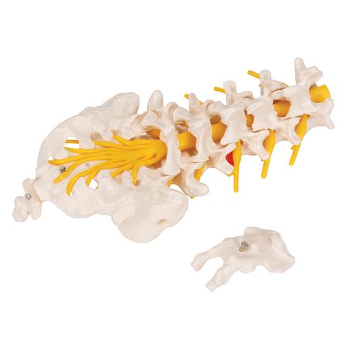 Lendenwirbelsäulenmodell mit dorsolateralem Bandscheibenvorfall - 3B Smart Anatomy, 1000150 [A76/5], Wirbelmodelle