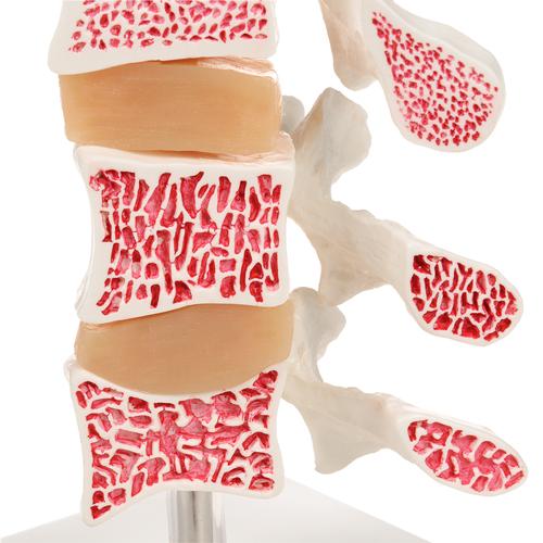 Osteoporose Modell mit 3 Lendenwirbeln, auf Stativ - 3B Smart Anatomy, 1000153 [A78], Arthritis und Osteoporose