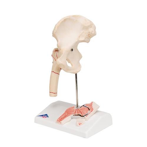 Hüftgelenkmodell mit Oberschenkelbruch & Hüftgelenkverschleiß - 3B Smart Anatomy, 1000175 [A88], Gelenkmodelle