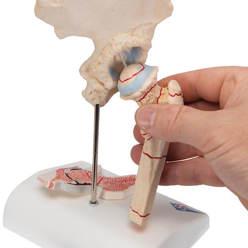 Hüftgelenkmodell mit Oberschenkelbruch & Hüftgelenkverschleiß - 3B Smart Anatomy, 1000175 [A88], Arthritis und Osteoporose