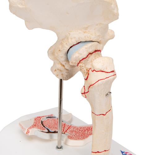 Hüftgelenkmodell mit Oberschenkelbruch & Hüftgelenkverschleiß - 3B Smart Anatomy, 1000175 [A88], Arthritis und Osteoporose