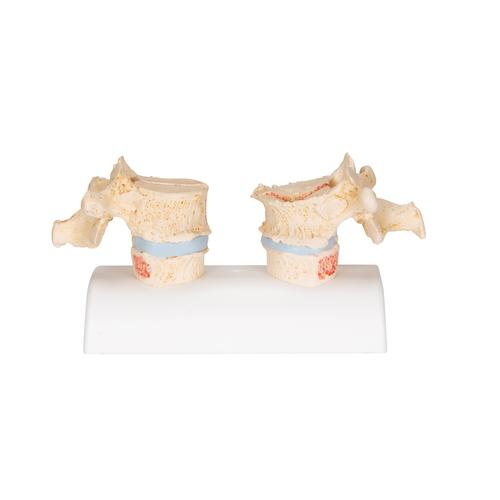 Osteoporose Modell des 11. und 12. Brustwirbels - 3B Smart Anatomy, 1000182 [A95], Wirbelmodelle