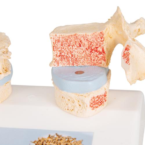 Osteoporose Modell des 11. und 12. Brustwirbels - 3B Smart Anatomy, 1000182 [A95], Wirbelsäulenmodelle