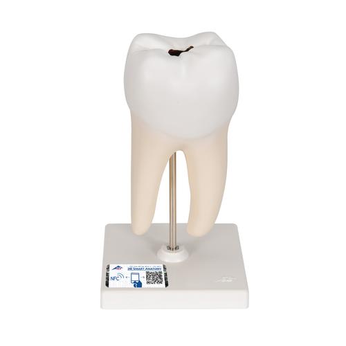 Zahn Modell Unterer Zweiwurzeliger Molar mit Karies, 2-teilig - 3B Smart Anatomy, 1000243 [D10/4], Ersatzteile