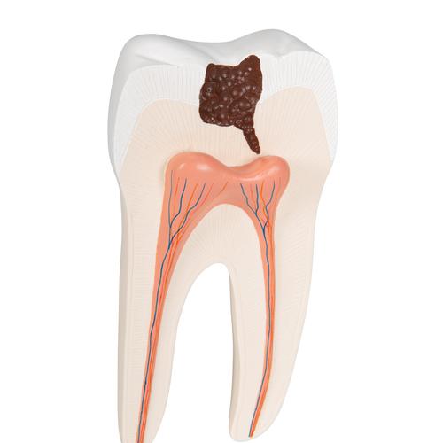 Zahn Modell Unterer Zweiwurzeliger Molar mit Karies, 2-teilig - 3B Smart Anatomy, 1000243 [D10/4], Zahnmodelle