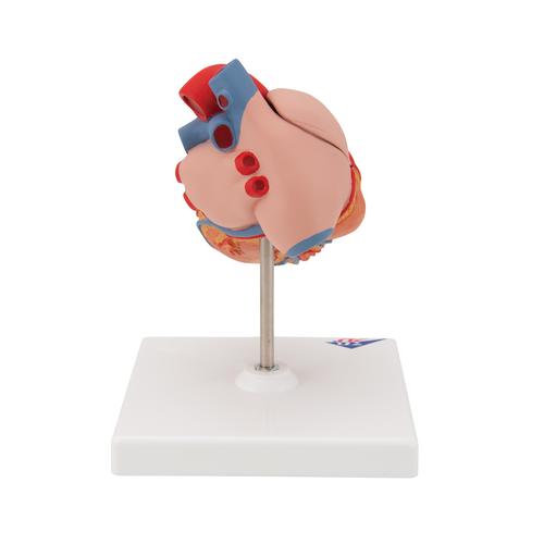 Herzmodell "Klassik" mit linksventrikulärer Hypertrophie (LVH), 2-teilig - 3B Smart Anatomy, 1000261 [G04], Herz- und Kreislaufmodelle