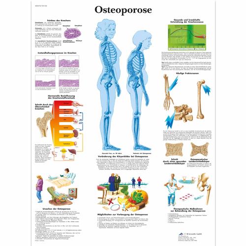 Lehrtafel - Osteoporose, 4006570 [VR0121UU], Skelettsystem