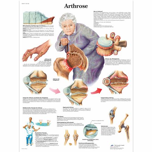 Lehrtafel - Arthrose, 1001308 [VR0123L], Arthritis und Osteoporose