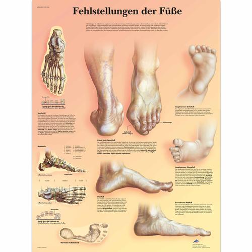 Lehrtafel - Fehlstellungen der Füße, 1001326 [VR0185L], Skelettsystem