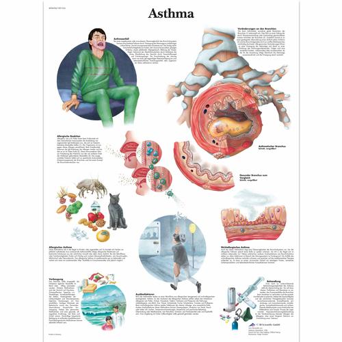 Lehrtafel - Asthma, 1001354 [VR0328L], Asthma und Allergien