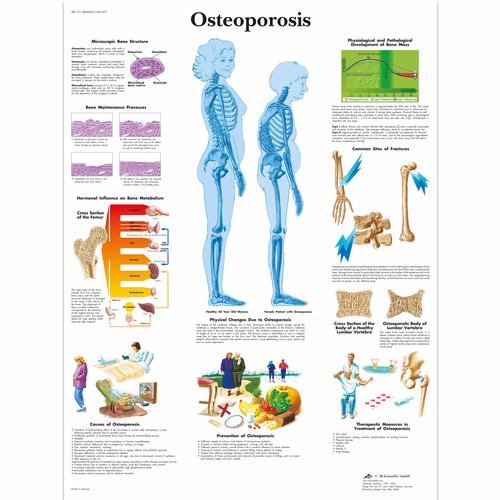 Lehrtafel - Osteoporosis, 1001472 [VR1121L], Skelettsystem