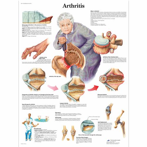 Lehrtafel - Arthritis, 4006654 [VR1123UU], Arthritis und Osteoporose