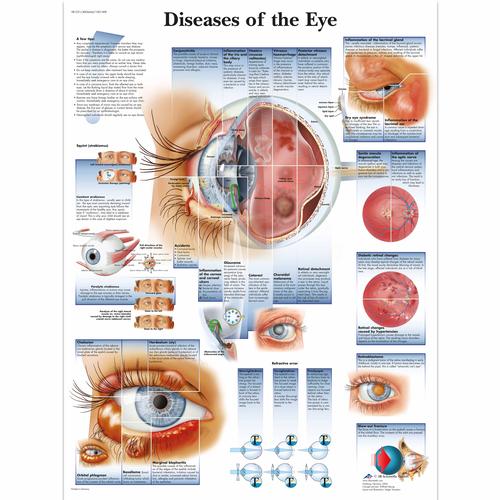 Lehrtafel - Diseases of the Eye, 4006666 [VR1231UU], Augen