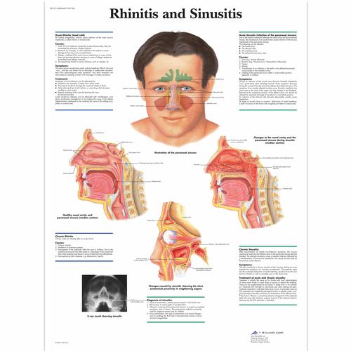 Lehrtafel - Rhinitis and Sinusitis, 1001504 [VR1251L], Hals, Nasen und Ohren (HNO)