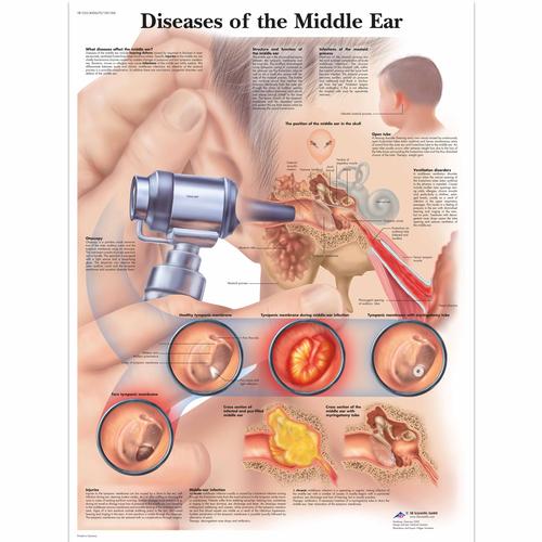 Lehrtafel - Diseases of the Middle Ear, 1001506 [VR1252L], Hals, Nasen und Ohren (HNO)
