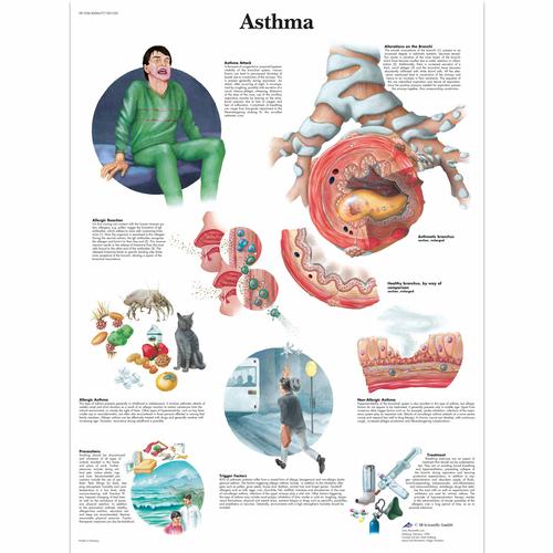 Lehrtafel - Asthma, 1001520 [VR1328L], Atmungssystem