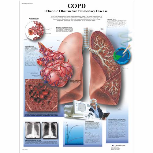 Lehrtafel - COPD Chronic Obstructive Pulmonary Disease, 4006678 [VR1329UU], Atmungssystem