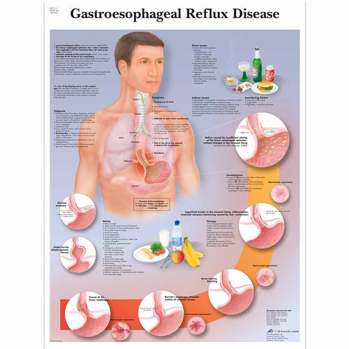 Lehrtafel - Gastroesophageal reflux disease, 4006718 [VR1711UU], Verdauungssystem
