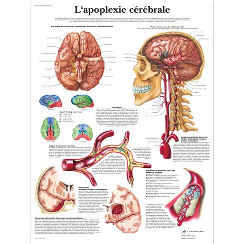 Lehrtafel - L'apoplexie cérébrale, 1001758 [VR2627L], Herz-Kreislauf-System