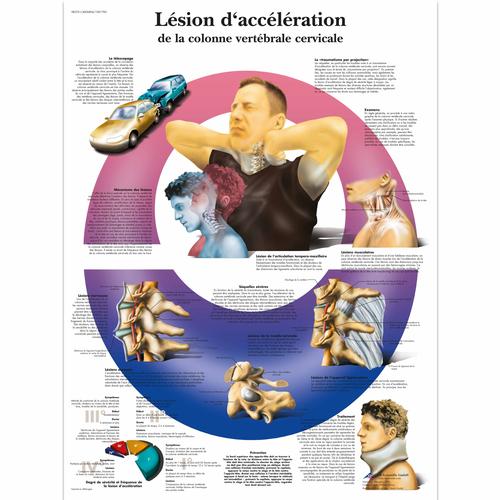 Lehrtafel - Lésion d’acceleration de la colonne vertébrale cervicale, 1001783 [VR2761L], Skelettsystem