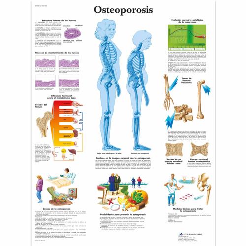 Lehrtafel - Osteoporosis, 4006816 [VR3121UU], Arthritis und Osteoporose