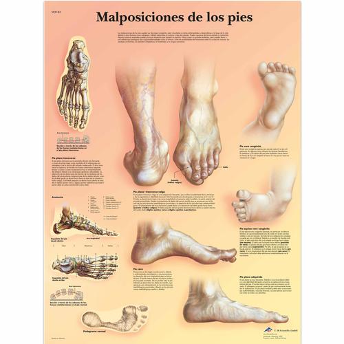 Lehrtafel - Malposiciones de los pies, 1001823 [VR3185L], Skelettsystem