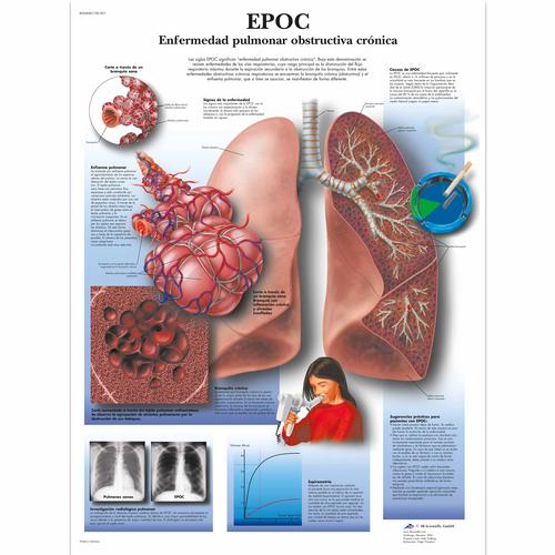 Lehrtafel - BPCO Broncho-pneumopathies chroniques obstructives, 1001851 [VR3329L], Gefahren des Rauchens