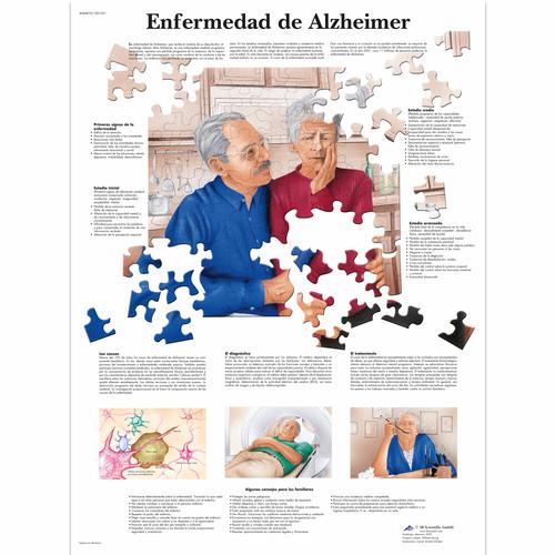 Lehrtafel - Enfermedad de Alzheimer, 4006875 [VR3628UU], Gehirn und Nervensystem
