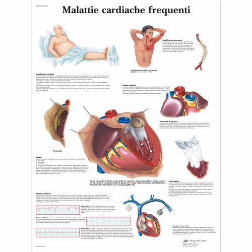 Lehrtafel - Malattie cardiache frequenti, 1002027 [VR4343L], Herzgesundheit und Fitnesserziehung
