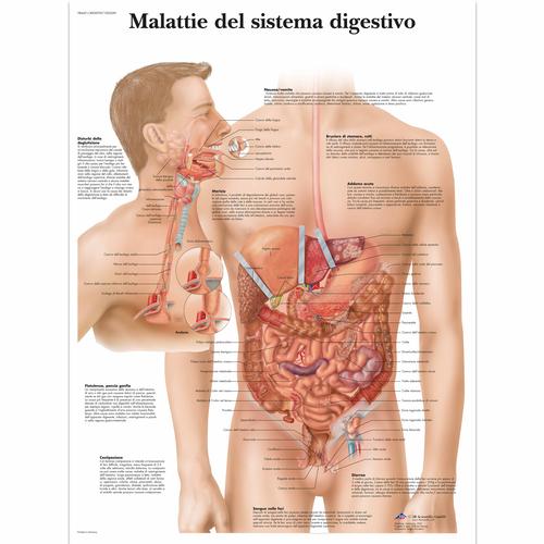 Lehrtafel - Malattie del sistema digestívo, 1002049 [VR4431L], Verdauungssystem
