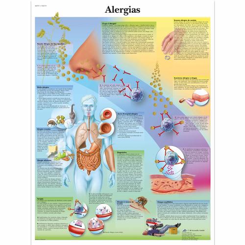 Alergias, 4007011 [VR5660UU], Immunsystem