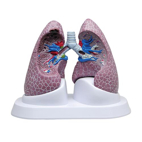 Lungen-Set mit Pathologien, 1018749 [W33371], Lungenmodelle