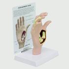 Modell einer Hand mit Osteoarthritis, 1019520, Gelenkmodelle