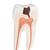 Zahn Modell Unterer Zweiwurzeliger Molar mit Karies, 2-teilig - 3B Smart Anatomy, 1000243 [D10/4], Zahnmodelle (Small)