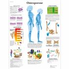 Lehrtafel - Osteoporose, 1001306 [VR0121L], Arthritis und Osteoporose