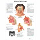 Lehrtafel - Rhinite et sinusite, 1001670 [VR2251L], Hals, Nasen und Ohren (HNO)