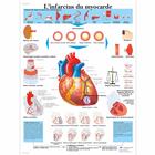 Lehrtafel - L'infarctus du myocarde, 1001692 [VR2342L], Herzgesundheit und Fitnesserziehung