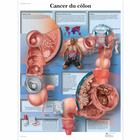 Lehrtafel - Cancer du côlon, 1001717 [VR2432L], Krebs