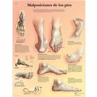 Lehrtafel - Malposiciones de los pies, 1001823 [VR3185L], Skelettsystem