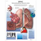 Lehrtafel - EPOC Enfermedad pulmonar obstructiva crónica, 4006840 [VR3329UU], Gefahren des Rauchens