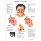 Lehrtafel - Rinite e sinusite, 4006916 [VR4251UU], Hals, Nasen und Ohren (HNO)