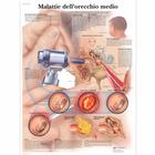 Lehrtafel - Malattie dell’orecchio medio, 4006917 [VR4252UU], Hals, Nasen und Ohren (HNO)