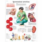 Lehrtafel - Ipertensione arteriosa, 1002033 [VR4361L], Herz-Kreislauf-System