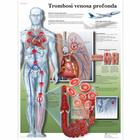 Lehrtafel - Trombose venosa profonda, 1002037 [VR4368L], Herz-Kreislauf-System