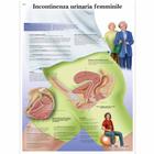 Lehrtafel - Incontinenza urinaria femminile, 1002071 [VR4542L], Gynäkologie